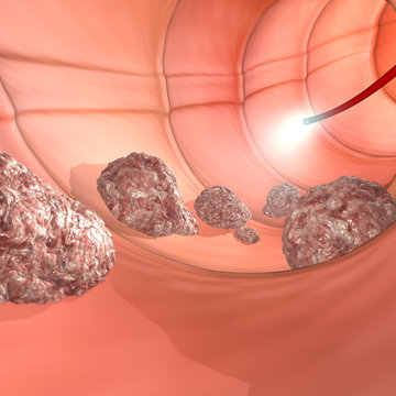 Colonscopia esame colon apparato digerente