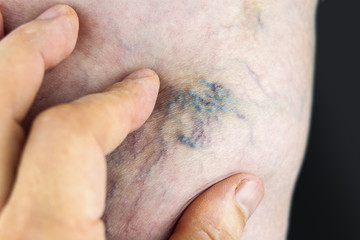 Varicose vein