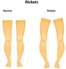 Rickets