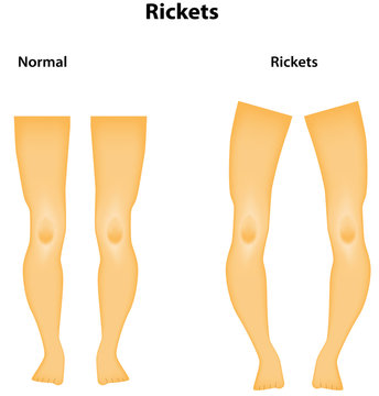 Rickets