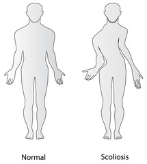 Scoliosis