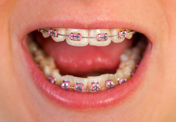 Pink braces