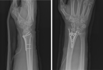 Xray of epiphysial radial fracture reduced