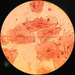 Herpes ulcer on tongue. Right bottom is normal healthy tongue, t