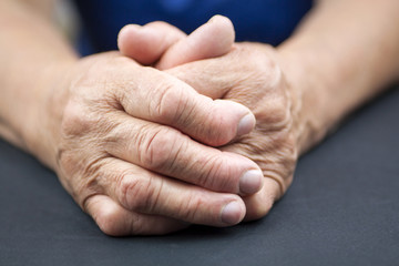 Hands Of Woman Deformed From Rheumatoid Arthritis - obrazy, fototapety, plakaty