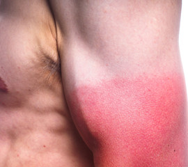 Sunburn on male biceps