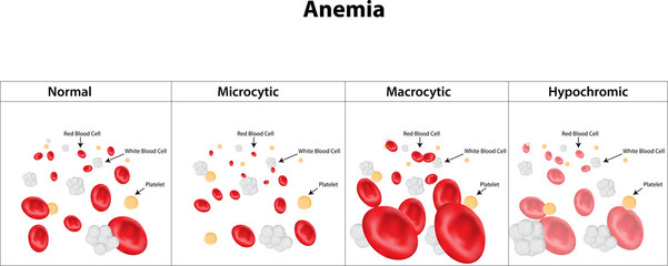 Microcytic, Macrocytic and Hypochromic Anemia - obrazy, fototapety, plakaty