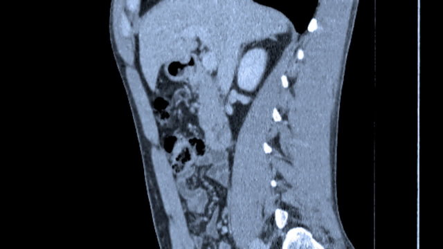CT Scan Video Slide Animations. Abdominal cross section slices o