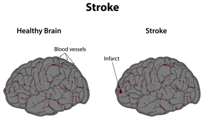 Stroke photos, royalty-free images, graphics, vectors & videos | Adobe ...