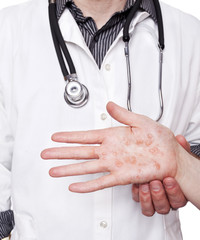 Dermatologist examining hand with severe eczema