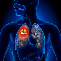 Lung Cancer - Tumor detail