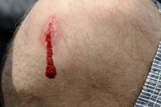 blutende Verletzung am Knie