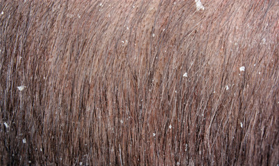 Dandruff in the hair