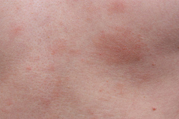 Fototapeta premium Example dermatological skin allergy