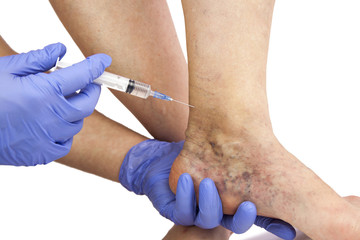 Varicose veins treatment