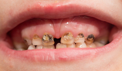 Obraz premium rotten teeth. macro