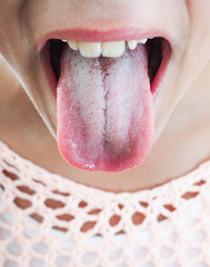 Protruding white plaque on tongue