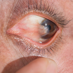 Eye exam