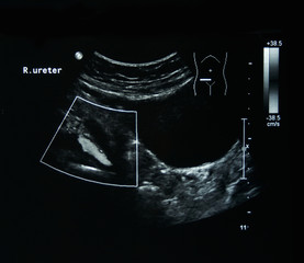 Ultrasound film of a woman right ureter abnormal