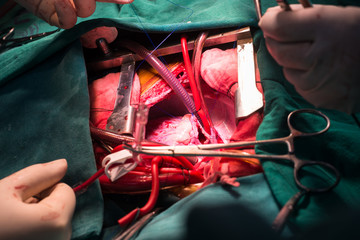 close right atrium after success operation