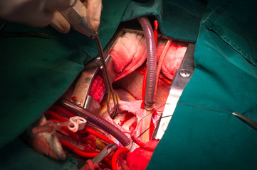 close ventricular septal defect via tricuspid valve