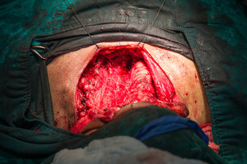 after total thyroidectomy