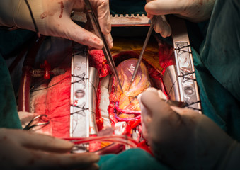 coronary artery bypass grafting open left anterior descending ar