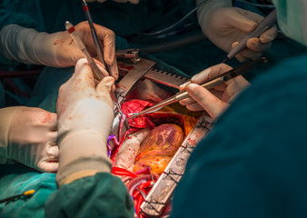 coronary artery bypass grafting diagonal artery anastomosis