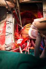 coronary artery bypass grafting obtuse marginal artery anastomos