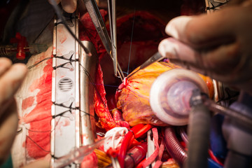 coronary artery bypass grafting obtuse marginal artery anastomos