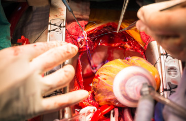coronary artery bypass grafting obtuse marginal artery anastomos