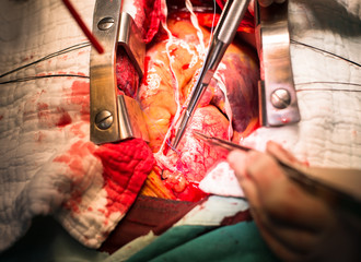make suture ascending aorta