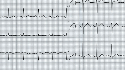 Electrocardiography of heart beat
