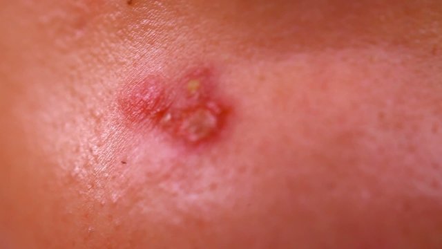 Close up of Acne skin because the disorders Of sebaceous glands