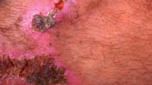 Close up of scars and wounds on hairy male leg. Macro video