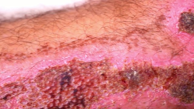 Close up of scars and wounds on hairy male leg. Macro video