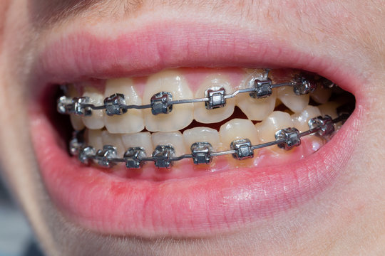 Mouth with bracket
