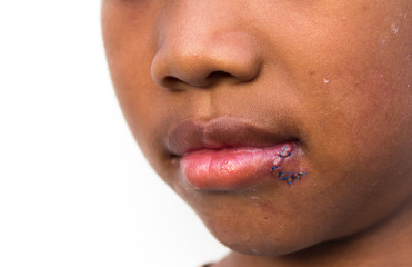 Obraz premium Stitches at the mouth of the boy