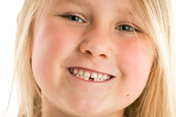 little girl with missing teeth