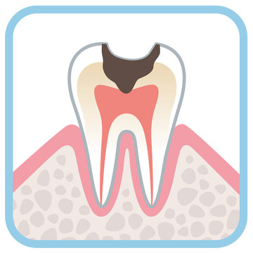 歯の断面図　虫歯