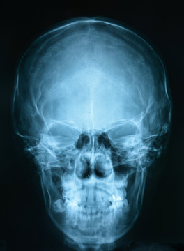X-ray picture of the skull 