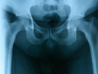 Rontgen picture of male pelvis