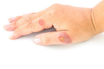 Hand a teenager with blisters due to burns