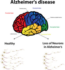 Alzheimer's Disease