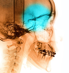 X-Ray scan human