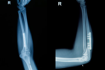 Film x-ray wrist fracture : show fracture radius bone