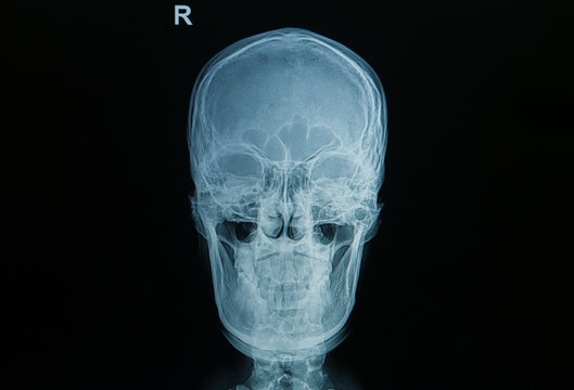 X-ray picture of the skull