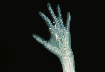 Film x-ray of hand fracture