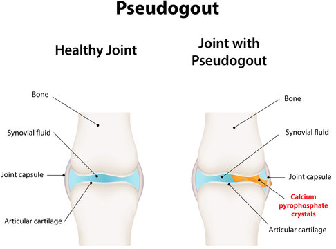 Pseudogout