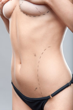 Woman belly marked out for cosmetic surgery